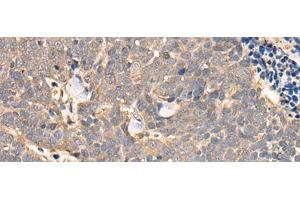 Immunohistochemistry of paraffin-embedded Human thyroid cancer tissue using NCAPH Polyclonal Antibody at dilution of 1:45(x200) (NCAPH anticorps)