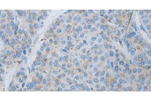 Immunohistochemistry of paraffin-embedded Human liver cancer using MMP25 Polyclonal Antibody at dilution of 1:80 (MMP25 anticorps)