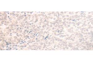 Immunohistochemistry of paraffin-embedded Human ovarian cancer tissue using EME2 Polyclonal Antibody at dilution of 1:40(x200) (EME2 anticorps)