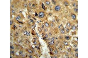 IHC analysis of FFPE human hepatocarcinoma stained with TAT antibody (Tat (AA 279-306) anticorps)