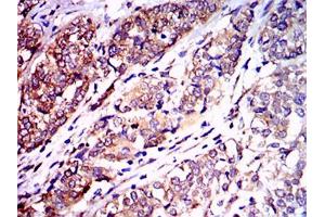 Immunohistochemical analysis of paraffin-embedded bladder cancer tissues using NEFL mouse mAb with DAB staining. (NEFL anticorps)