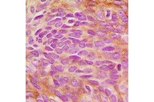 Immunohistochemical analysis of ERK5 staining in human breast cancer formalin fixed paraffin embedded tissue section.