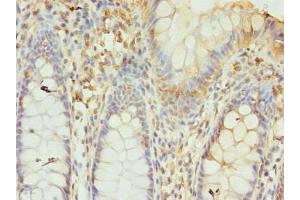 Immunohistochemistry of paraffin-embedded human colon cancer using ABIN7153785 at dilution of 1:100 (GTF3C6 anticorps  (AA 2-213))