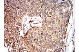 Immunohistochemical analysis of paraffin-embedded bladder cancer tissues using VP2 mouse mAb with DAB staining. (VP2 (AA 296-438) anticorps)