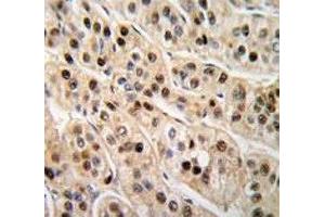 IHC analysis of FFPE human hepatocarcinoma tissue stained with PCNA antibody (PCNA anticorps  (AA 231-261))