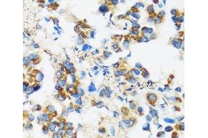 Immunohistochemistry of paraffin-embedded Human lung cancer using APOBEC3F Polyclonal Antibody at dilution of 1:100 (40x lens). (APOBEC3F anticorps)