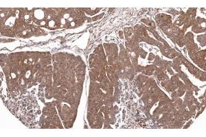 IHC-P Image Immunohistochemical analysis of paraffin-embedded Gastric CA N87 xenograft, using RPL5, antibody at 1:100 dilution. (RPL5 anticorps)