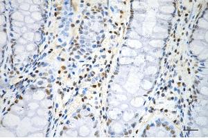 Immunohistochemistry was performed on paraffin-embedded human sigmoid colon carcinoma using phospho-histone H3 (S28) antibody (ABIN7798976), 1:200). (Recombinant Histone 3 anticorps  (H3S28ph))