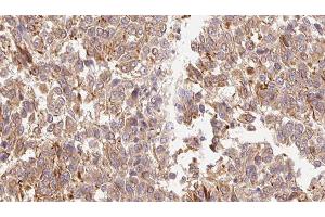 ABIN6278899 at 1/100 staining Human Melanoma tissue by IHC-P. (IL-3 anticorps  (Internal Region))