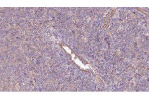 ABIN6273064 at 1/100 staining Human lymph cancer tissue by IHC-P. (PHGDH anticorps  (N-Term))