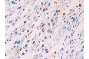 Detection of PROS in Human Stomach cancer Tissue using Polyclonal Antibody to Protein S (PROS) (PROS1 anticorps  (AA 481-667))