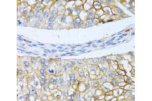Immunohistochemistry of paraffin-embedded Human prostate cancer using BMP4 Polyclonal Antibody at dilution of 1:100 (40x lens). (BMP4 anticorps)