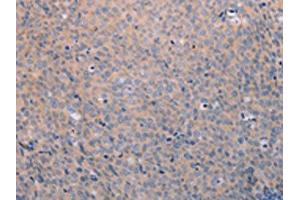 The image on the left is immunohistochemistry of paraffin-embedded Human cervical cancer tissue using ABIN7189808(ANKRD26 Antibody) at dilution 1/25, on the right is treated with synthetic peptide. (ANKRD26 anticorps)