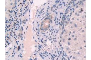 Detection of OAS1 in Human Liver cancer Tissue using Polyclonal Antibody to 2',5'-Oligoadenylate Synthetase 1 (OAS1) (OAS1 anticorps  (AA 74-165))