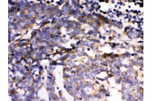 Anti- MAPK6 Picoband antibody, IHC(P) IHC(P): Human Lung Cancer Tissue (MAPK6 anticorps  (AA 520-721))