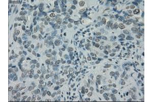 Immunohistochemical staining of paraffin-embedded Carcinoma of thyroid tissue using anti-PRKYmouse monoclonal antibody. (PRKY anticorps)