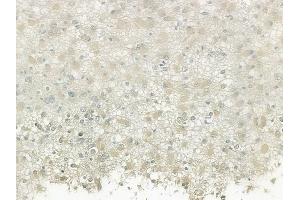 ABIN6258144 and ABIN6273844 at 1/100 staining human thyroid carcinoma by IHC-P.