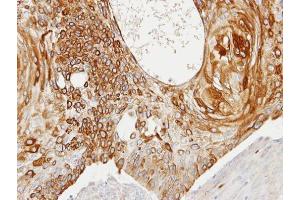 IHC-P Image Immunohistochemical analysis of paraffin-embedded HSC3 xenograft, using Creatine kinase (brain), antibody at 1:100 dilution.