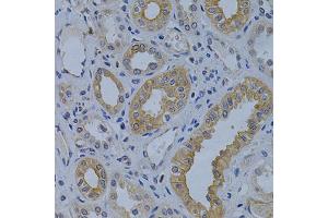 Immunohistochemistry of paraffin-embedded human kidney cancer using MVP Antibody (ABIN1873787) at dilution of 1:200 (40x lens). (MVP anticorps)