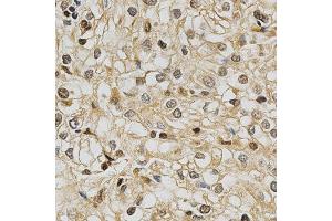 Immunohistochemistry of paraffin-embedded human kidney cancer using GSTT1 antibody at dilution of 1:200 (x400 lens)