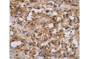 Immunohistochemistry of Human liver cancer using E2F4 Polyclonal Antibody at dilution of 1:40