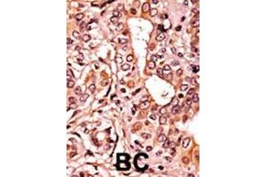Formalin-fixed and paraffin-embedded human cancer tissue reacted with the primary antibody, which was peroxidase-conjugated to the secondary antibody, followed by AEC staining.
