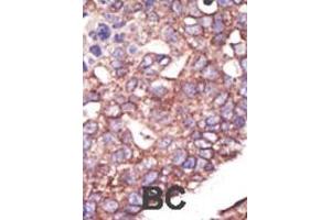 Formalin-fixed and paraffin-embedded human cancer tissue reacted with the primary antibody, which was peroxidase-conjugated to the secondary antibody, followed by DAB staining.