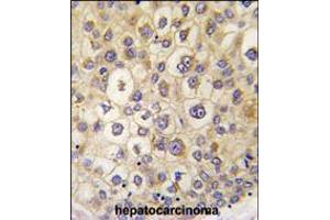 Formalin-fixed and paraffin-embedded human hepatocarcinoma tissue reacted with ARHE antibody , which was peroxidase-conjugated to the secondary antibody, followed by DAB staining.