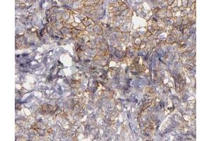 ABIN6268685 at 1/100 staining human lung carcinoma tissue sections by IHC-P. (CD9 anticorps  (Internal Region))