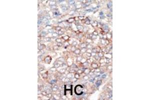 Formalin-fixed and paraffin-embedded human cancer tissue reacted with the primary antibody, which was peroxidase-conjugated to the secondary antibody, followed by DAB staining.