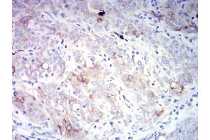 Immunohistochemical analysis of paraffin-embedded cervical cancer tissues using CD66A mouse mAb with DAB staining. (CEACAM1 anticorps  (AA 65-201))