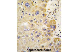 Formalin-fixed and paraffin-embedded human hepatocellular carcinoma reacted with ALDH2 polyclonal antibody  , which was peroxidase-conjugated to the secondary antibody, followed by DAB staining. (ALDH2 anticorps  (Internal Region))