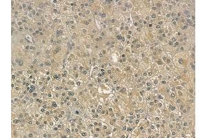 ABIN6257240 and ABIN6275170 at 1/100 staining human hepatocellular carcinoma by IHC-P. (GIMAP5 anticorps  (Internal Region))