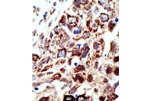 Formalin-fixed and paraffin-embedded human cancer tissue reacted with the primary antibody, which was peroxidase-conjugated to the secondary antibody, followed by AEC staining. (STAM anticorps  (C-Term))
