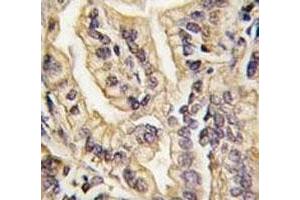 IHC analysis of FFPE human lung carcinoma tissue stained with CSF1R antibody (CSF1R anticorps  (AA 940-971))