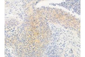 ABIN6263140 and ABIN6266983 at 1/100 staining human gastric carcinoma by IHC-P. (MAST4 anticorps  (N-Term))
