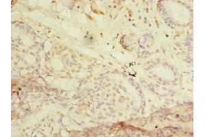 Immunohistochemistry of paraffin-embedded human breast cancer using ABIN7168022 at dilution of 1:100 (RHOC anticorps  (AA 1-190))