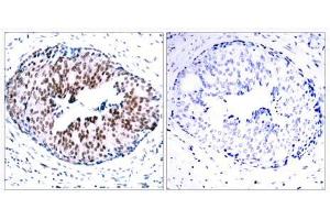 Immunohistochemical analysis of paraffin- embedded human breast carcinoma tissue using STAT5A (phospho-Ser780) antibody (E011049). (STAT5A anticorps  (pSer780))