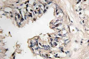 Immunohistochemistry (IHC) analyzes of MRP-S36 antibody in paraffin-embedded human prostate carcinoma tissue. (MRPS36 anticorps)
