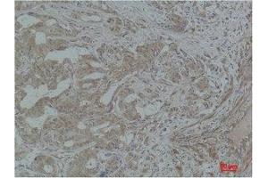 Immunohistochemistry (IHC) analysis of paraffin-embedded Human Breast Carcinoma using Stat3 Polyclonal Antibody. (STAT3 anticorps)