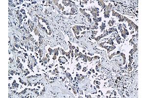 Formalin-fixed and paraffin embedded rat differentiated adenocarcinoma labeled with Anti ESAM Polyclonal Antibody, Unconjugated (ABIN758621) at 1:200 followed by conjugation to the secondary antibody and DAB staining (ESAM anticorps  (AA 21-120))