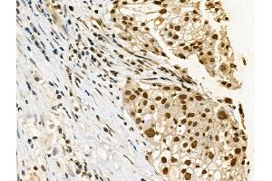 Phospho-p53 (Ser33) Antibody at 1/100 staining Human ovarian cancer by IHC-P. (p53 anticorps  (pSer33))