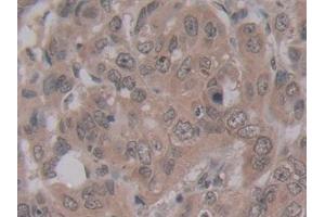 Detection of ENPP2 in Human Breast cancer Tissue using Monoclonal Antibody to Ectonucleotide Pyrophosphatase/Phosphodiesterase 2 (ENPP2)