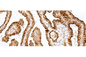 Immunohistochemistry of paraffin-embedded Human thyroid cancer tissue using SAXO2 Polyclonal Antibody at dilution of 1:40(x200) (FAM154B anticorps)
