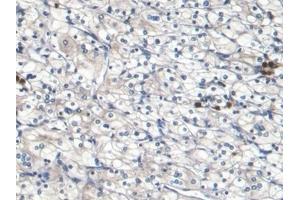 Detection of S100A8 in Human Renal cancer Tissue using Monoclonal Antibody to S100 Calcium Binding Protein A8 (S100A8)