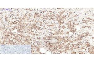 Immunohistochemistry of paraffin-embedded Human breast cancer tissue using LTF Monoclonal Antibody at dilution of 1:200. (Lactoferrin anticorps)