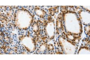 Immunohistochemistry of paraffin-embedded Human thyroid cancer tissue using SELENOS Polyclonal Antibody at dilution 1:40 (Selenoprotein S anticorps)