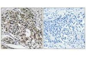 Immunohistochemistry analysis of paraffin-embedded human breast carcinoma tissue using MRPL13 antibody.