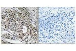 Immunohistochemistry analysis of paraffin-embedded human breast carcinoma tissue using MRPL13 antibody. (MRPL13 anticorps  (C-Term))
