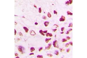 Immunohistochemical analysis of Cullin 1 staining in human lung cancer formalin fixed paraffin embedded tissue section.